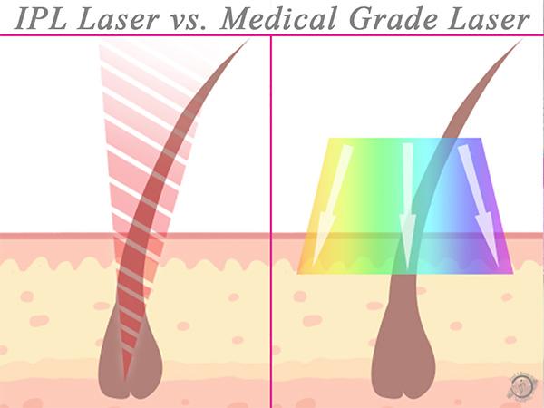 Top Medical-Grade Lasers for Swift, Smooth Hair Removal