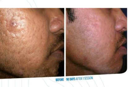 Zap That Crown: Er:YAG Lasers vs. Lithium Disilicate 14 Zap That Crown: Er:YAG Lasers vs. Lithium Disilicate