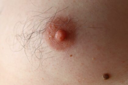 Navigating Nipple Laser Hair Removal: Risks & Realities