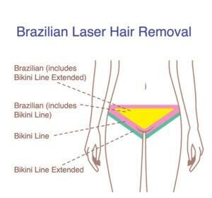 Brazilian Laser Hair Removal: The Bright Side and the Buzz 2 Brazilian Laser Hair Removal: The Bright Side and the Buzz