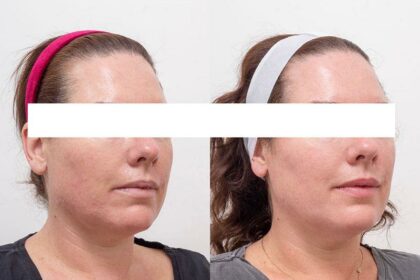 Radiant Revamps: Discover Q-Switch Laser Wonders 8 Radiant Revamps: Discover Q-Switch Laser Wonders