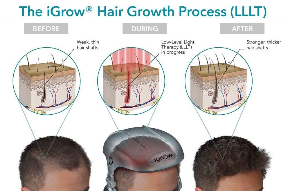 Bright Side or Balderdash? Unveiling Laser Hair Therapy