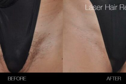 The Bikini Laser Lowdown: Benefits and Drawbacks Unveiled!