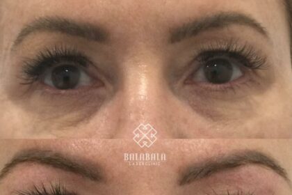 Laser Smooth: Weighing the Side Effects of Forever Hair-Free
