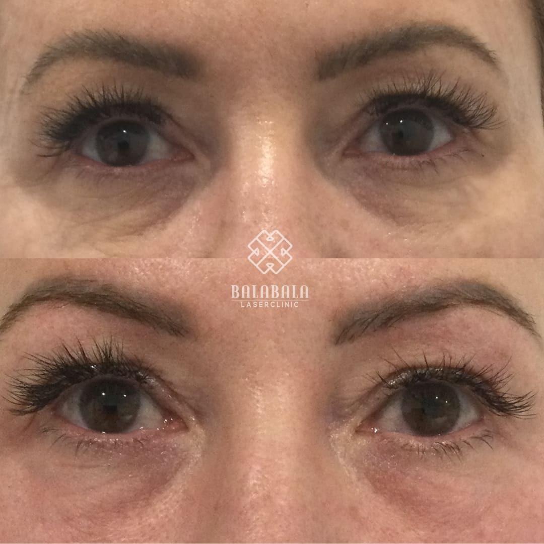 Laser Smooth: Weighing the Side Effects of Forever Hair-Free