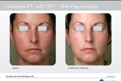 Glowing Soon: When to Expect Results from Your IPL Session