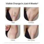 Zap and Go? The Truth About Instant Laser Hair Results