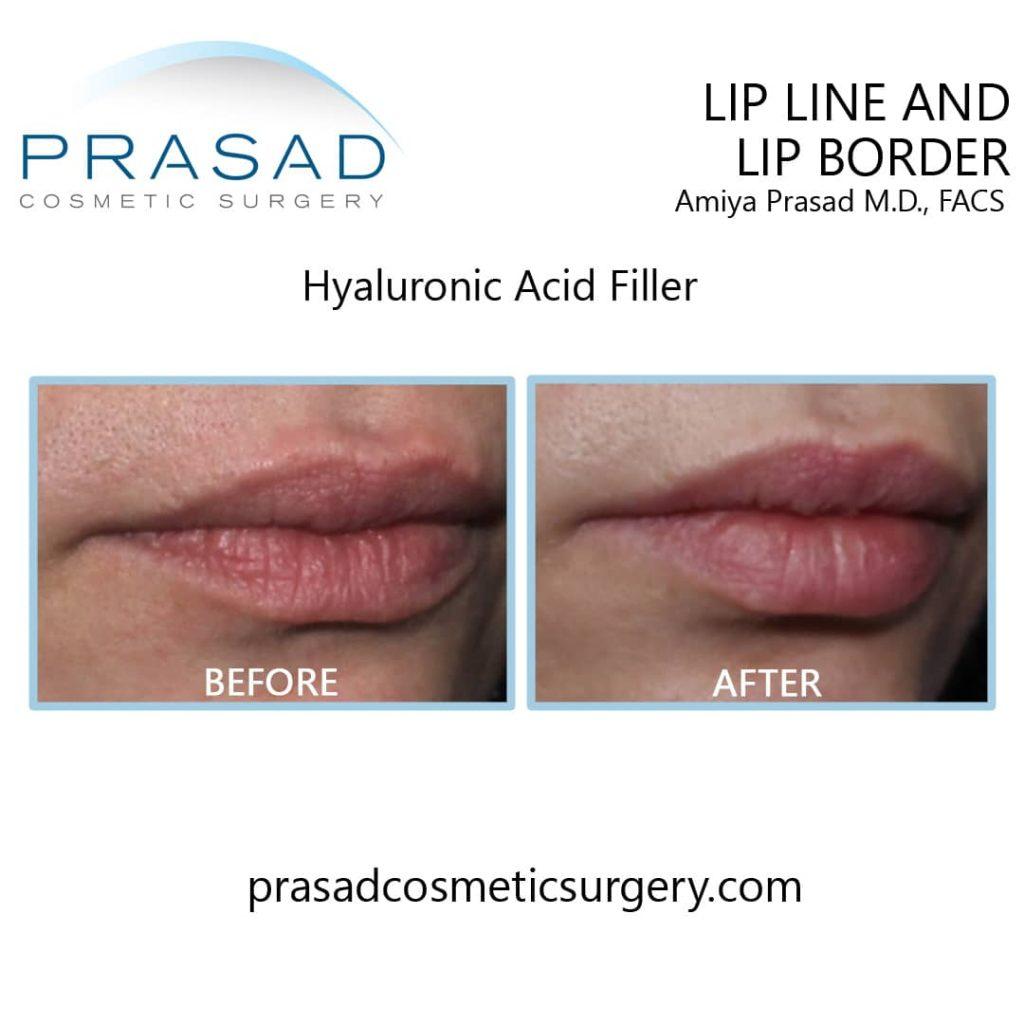 Understanding the True Cost of a Silky Smooth Upper Lip