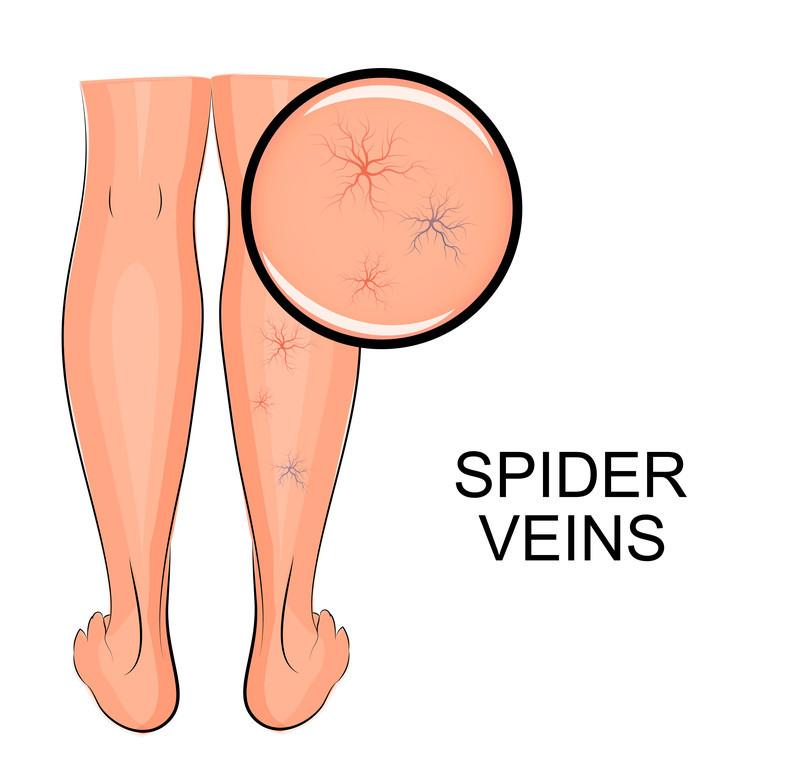 Wave Farewell to Imperfections: Banish Spider Veins Effortlessly