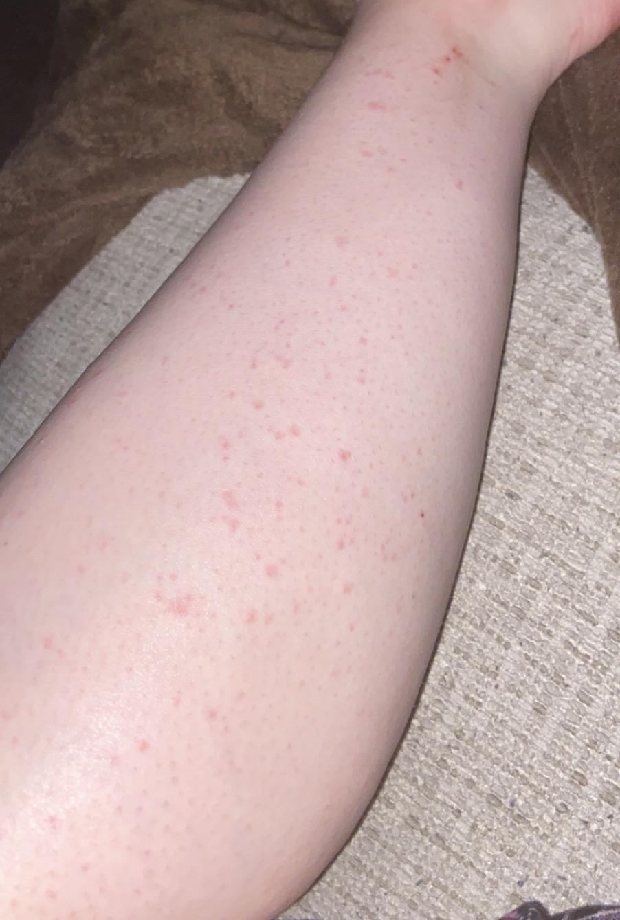 Say Goodbye to Razor Burns and Hello to Smooth Skin