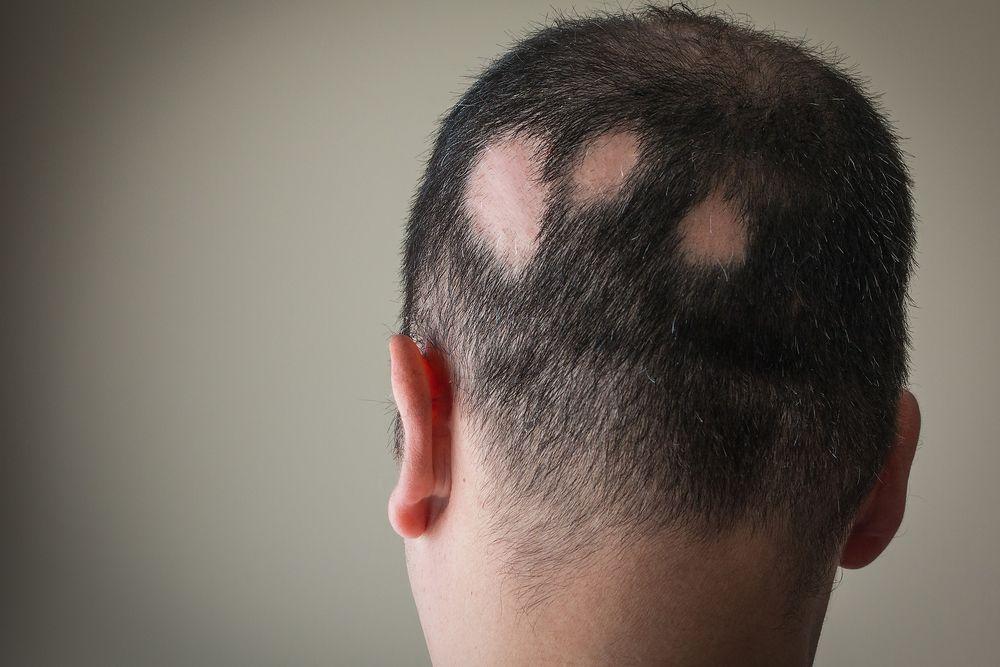 Hair Today, Gone Tomorrow: Preventing Stress-Related Hair Loss