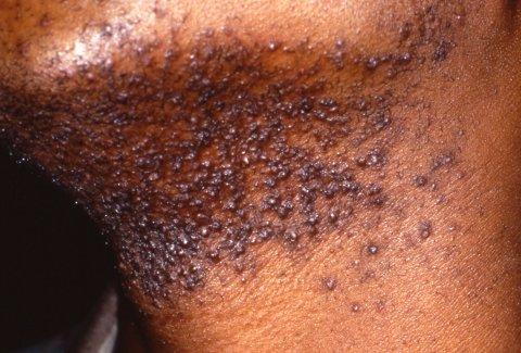 Farewell to Razor Burns: The Comfort of Laser⁤ Treatments