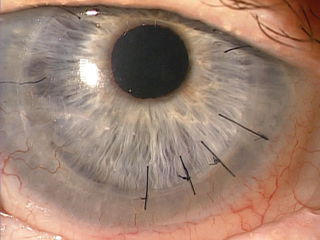 Future⁢ Innovations in Corneal Nerve Research