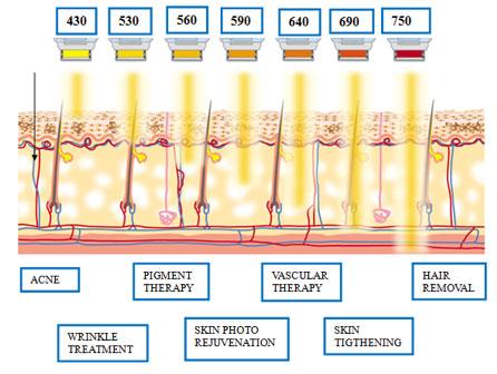 Understanding the Magic of IPL Technology