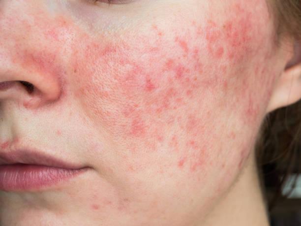 Pain-Free and Easy: Techniques for Sensitive Skin