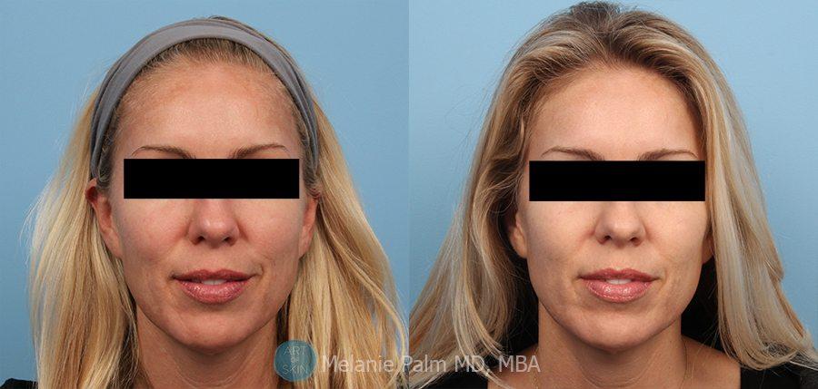 Pro Tips: Preparing for Your Spectrum Laser Session