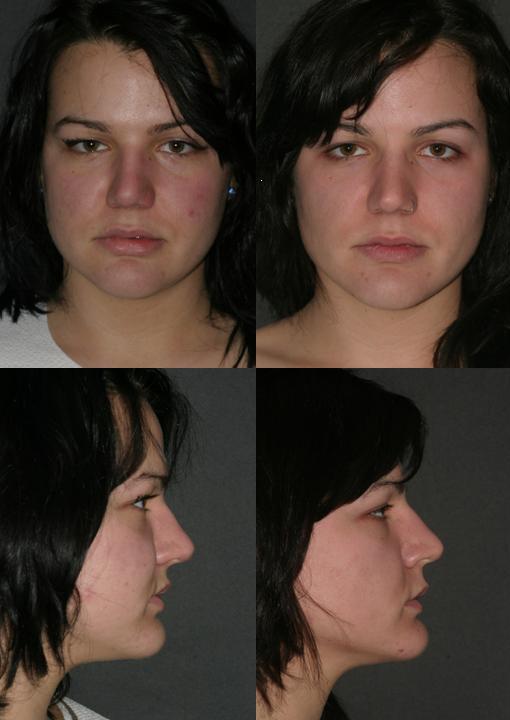 Top Reasons to Consider Buccal Fat Removal in St. Louis
