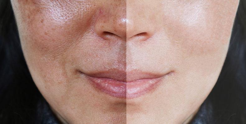 Avoiding Hyperpigmentation:‍ Best Practices for Maintaining Even Skin ⁣Tone
