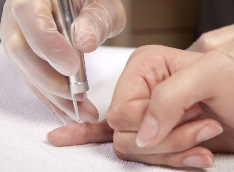 Preparing for Your Laser Wart Removal Session: What to Expect