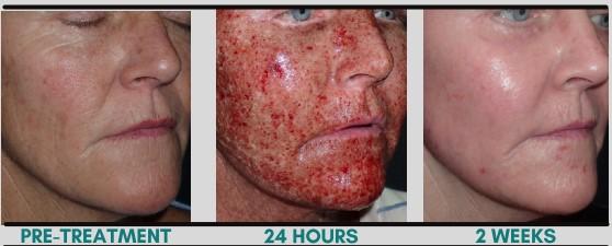The Treatment ‍Process: ⁢What to⁤ Expect ⁤During and After Your CO2​ Laser Session