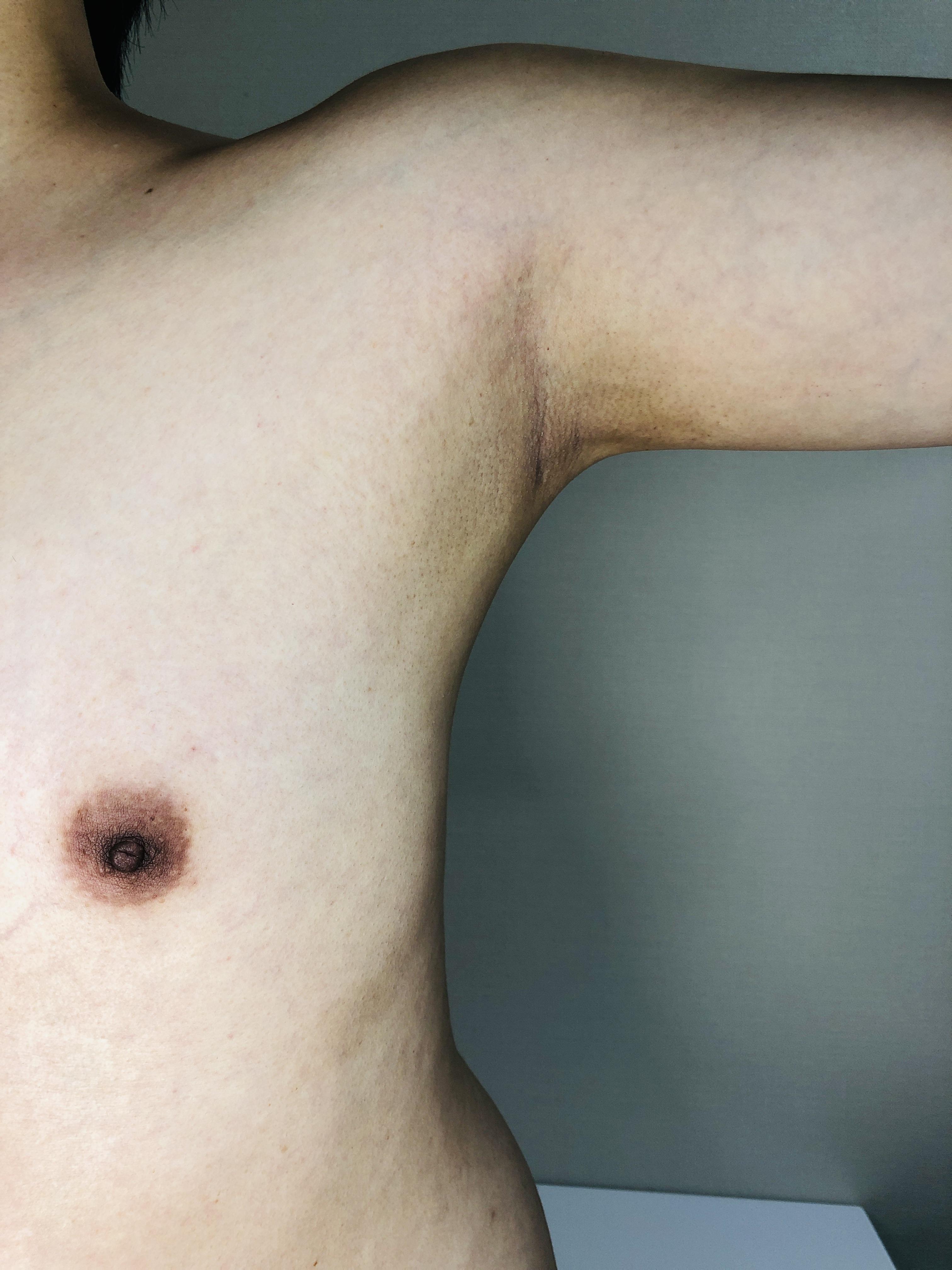 Understanding the Basics: What is Underarm Laser Hair Removal?