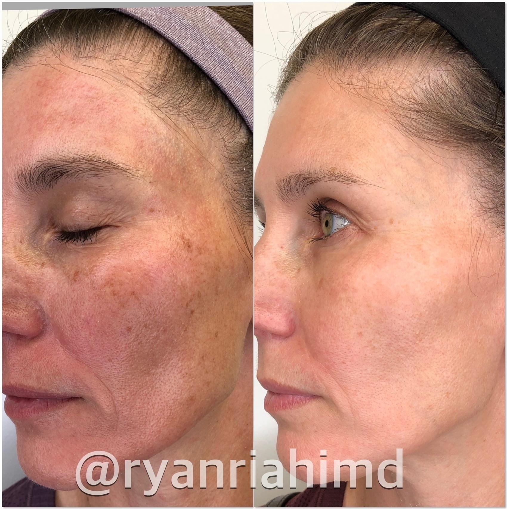 Understanding IPL: What Makes It Different from Other Hair Removal Methods