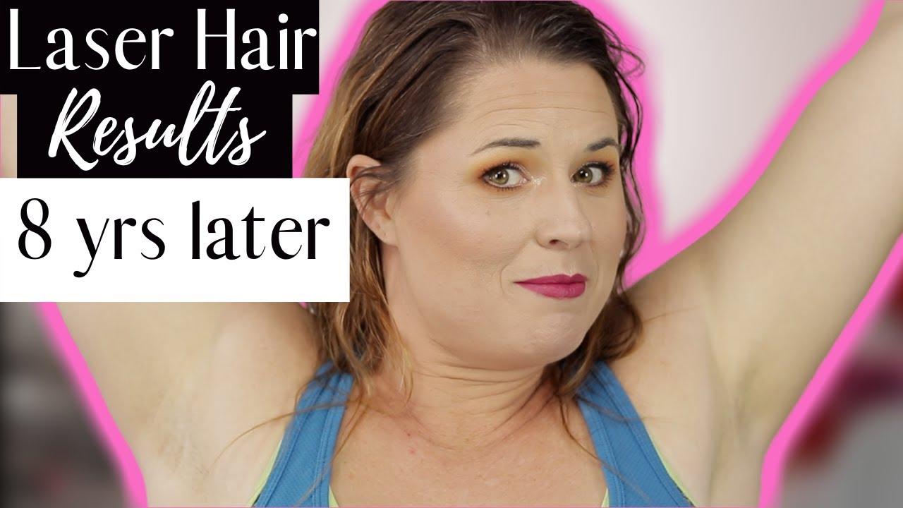 Navigating Common Myths About Long-Term Laser Hair Removal