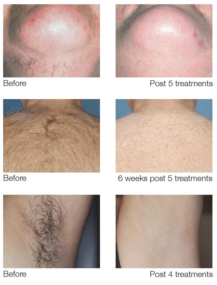Key Ingredients to Look For in Post-Laser Hair Removal Deodorants