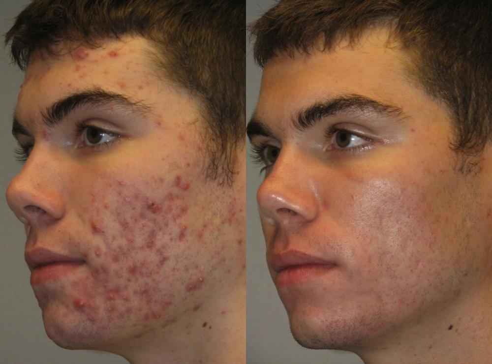 Tracking Progress: Monitoring Your Skin’s Transformation