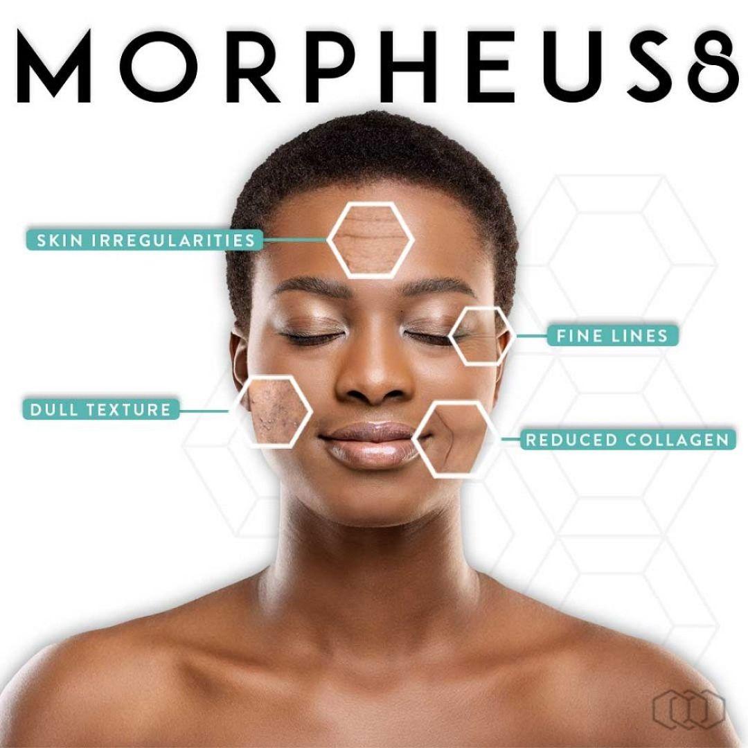 Mastering the ⁤Core: Why Morpheus8 Is a⁢ Game-Changer