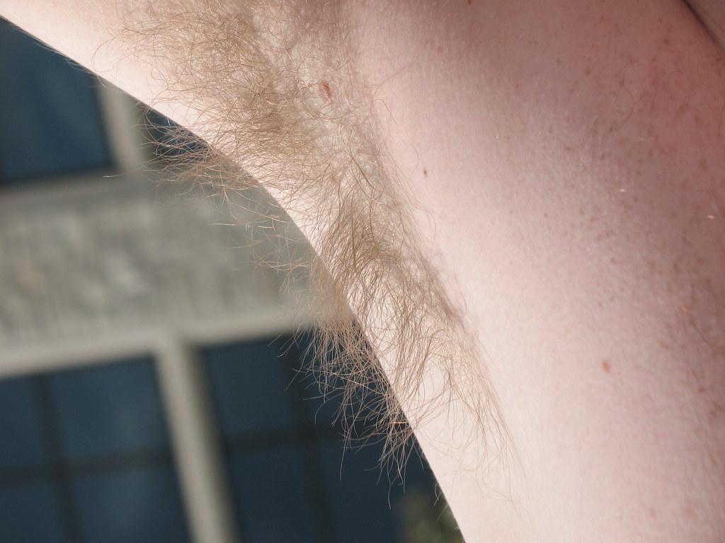 Feel the Freedom: Why Underarm Laser Treatment Boosts Confidence