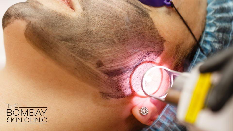 Understanding ⁢the Laser Treatment Process and Its Aftereffects