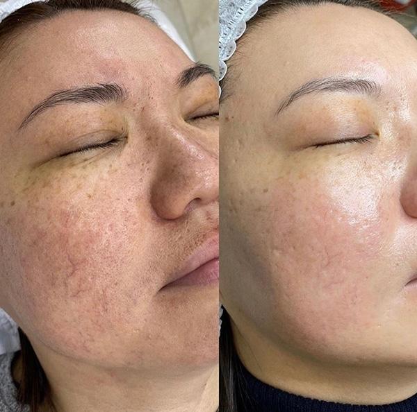 Er:YAG Laser: Unearthing the Science Behind the Sparkle