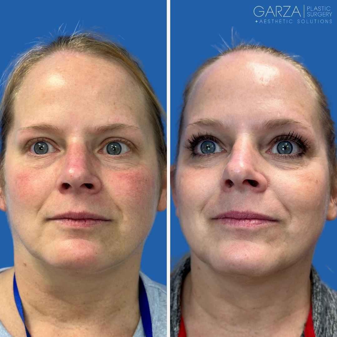 Prepping for Perfection: How to Get Ready for IPL Treatment