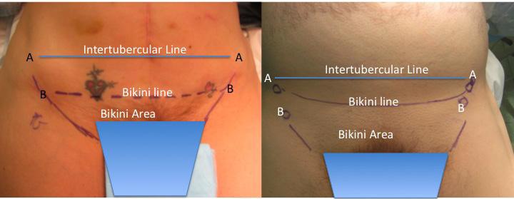 Smooth Sailing: The ⁢Ultimate Bikini Line Aftercare Guide