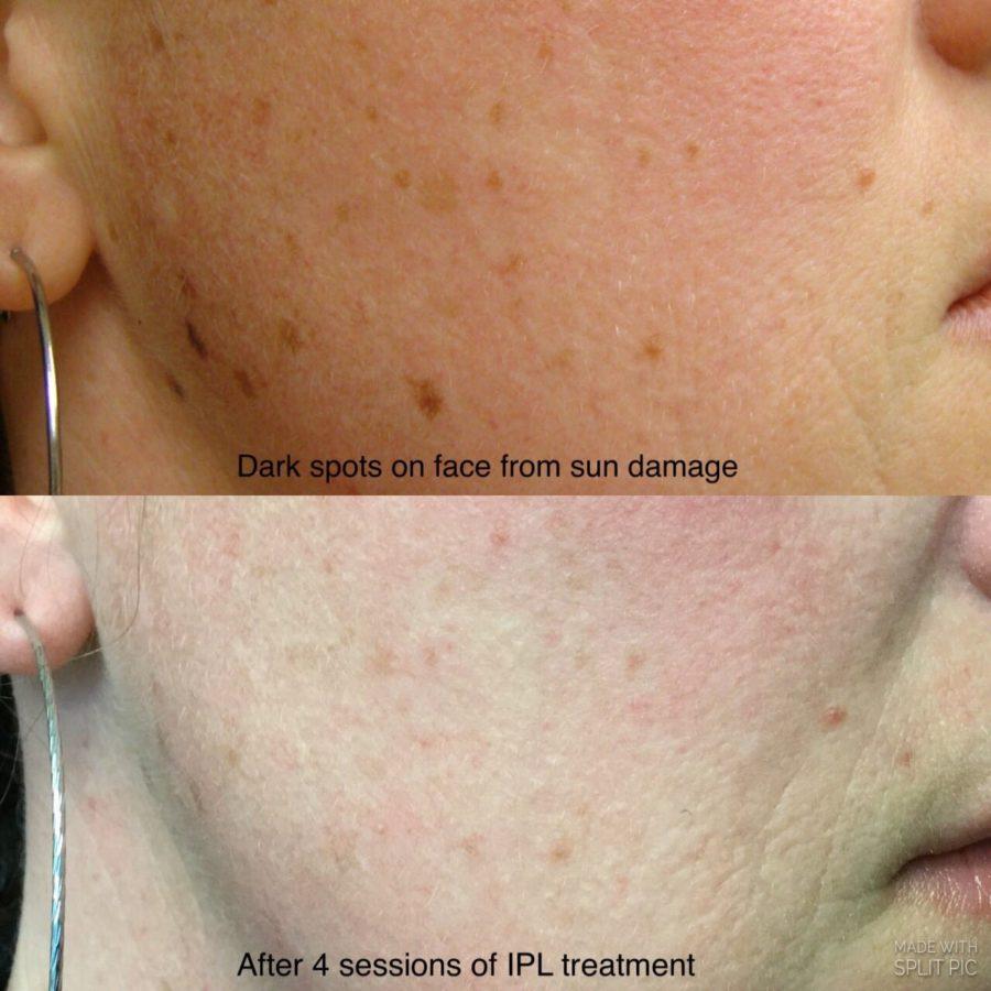 Step-by-Step: What to Expect During Your IPL Session
