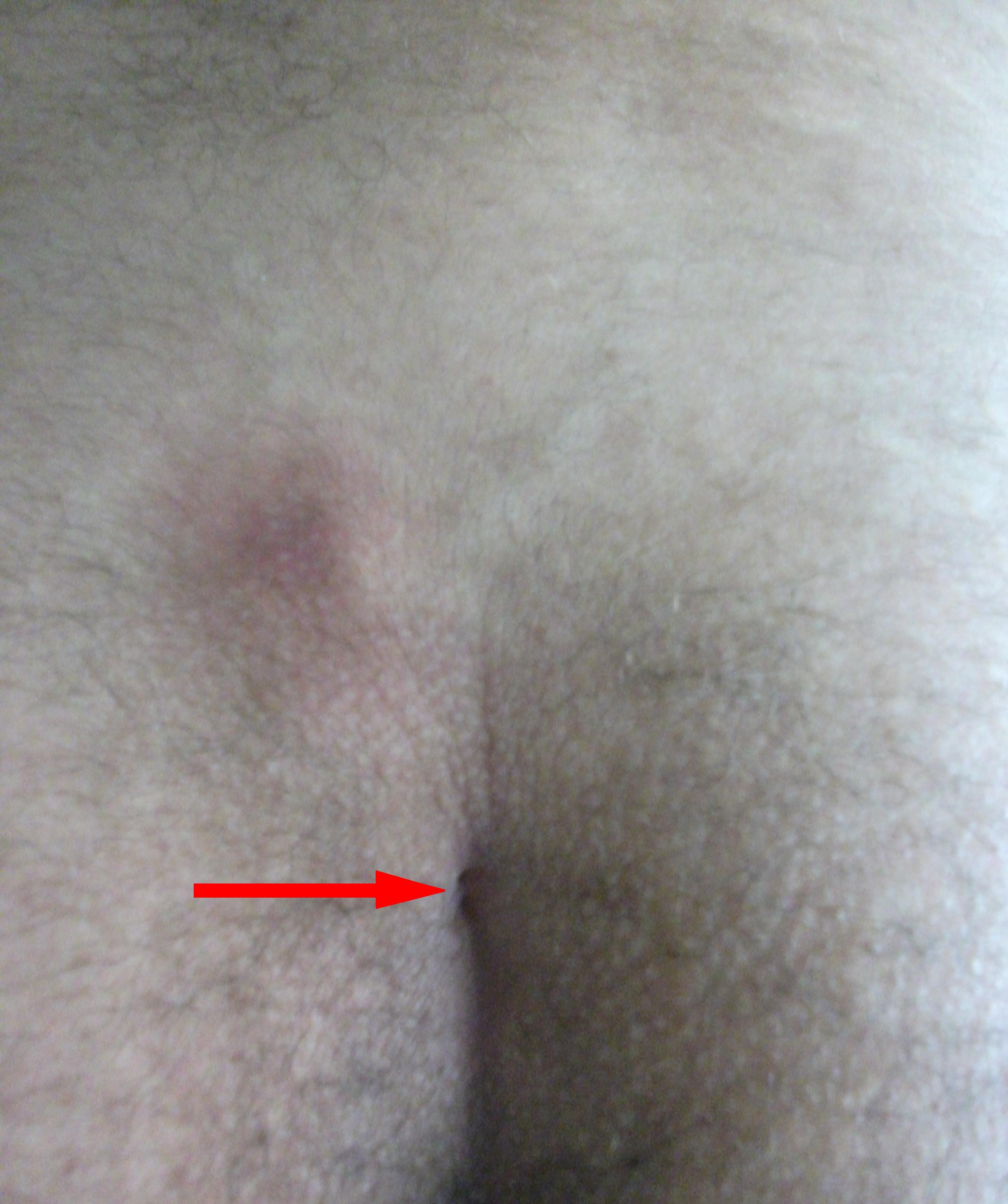 Understanding Pilonidal Sinus and Its Laser Treatment