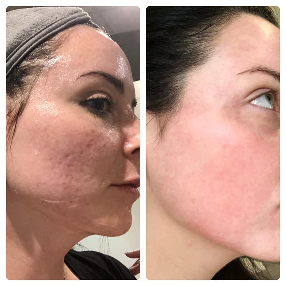 Candidates and Concerns: Is CO2 Laser​ Treatment Right for You?