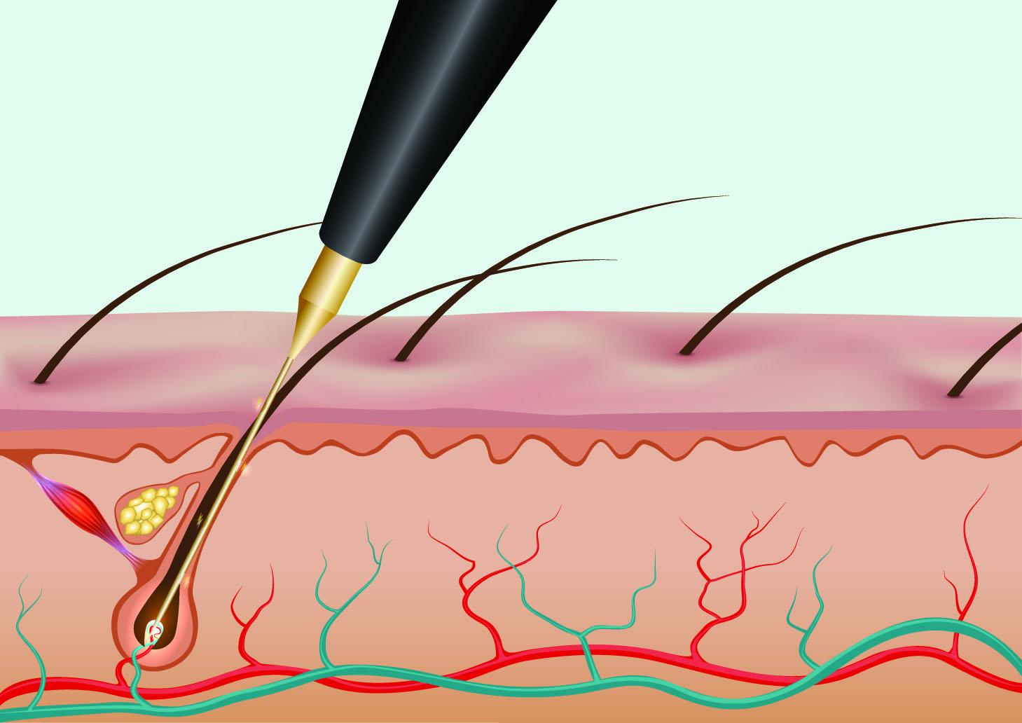 What to Expect From Your First Electrolysis Session