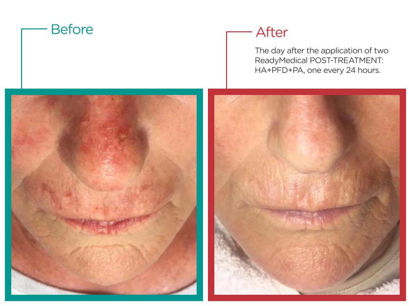 Smooth Sailing: The Lasting Impact of Leg Laser Hair Removal 5 Post-Treatment Pampering: How to Care for Your Skin