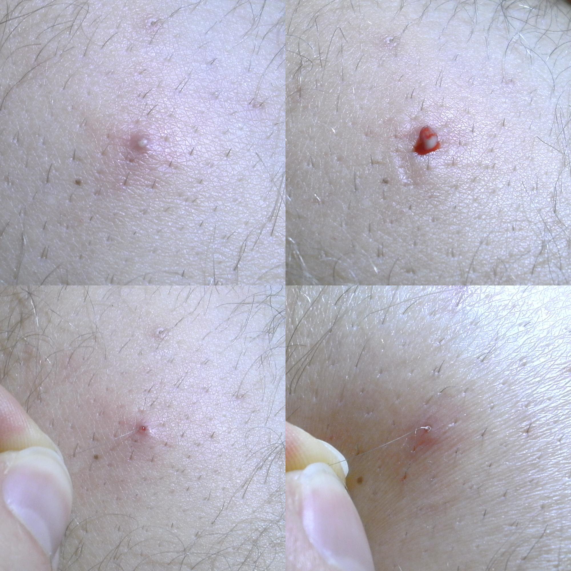 Banishing Bumps: How to Avoid and Treat Ingrown Hairs