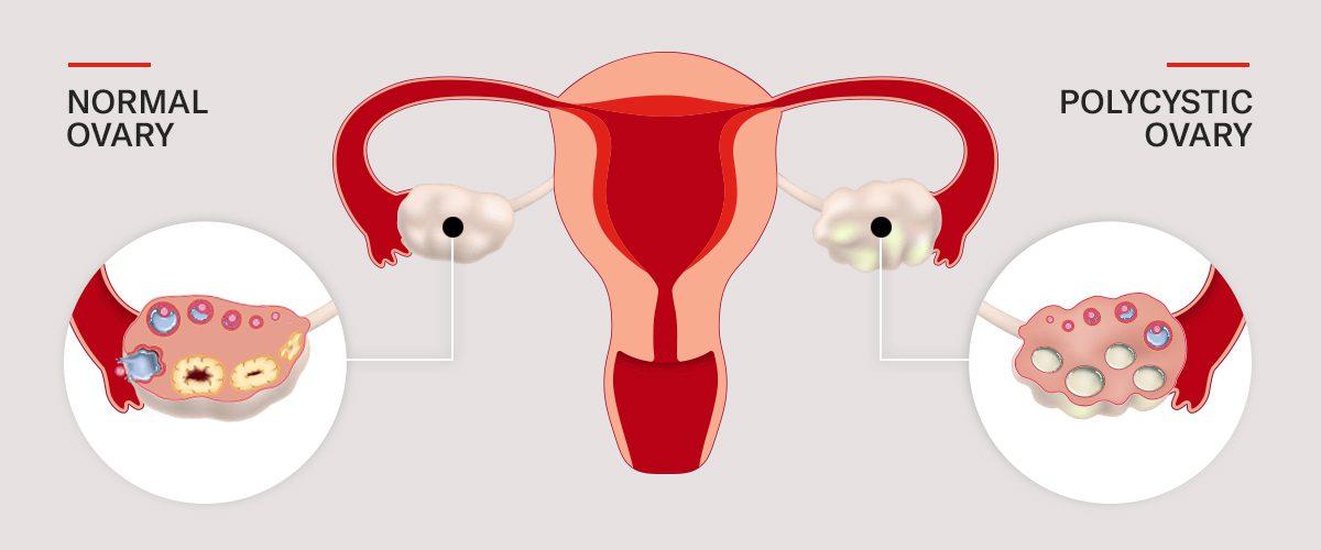 Real-Life⁣ Success Stories: PCOS Warriors Share Laser Results
