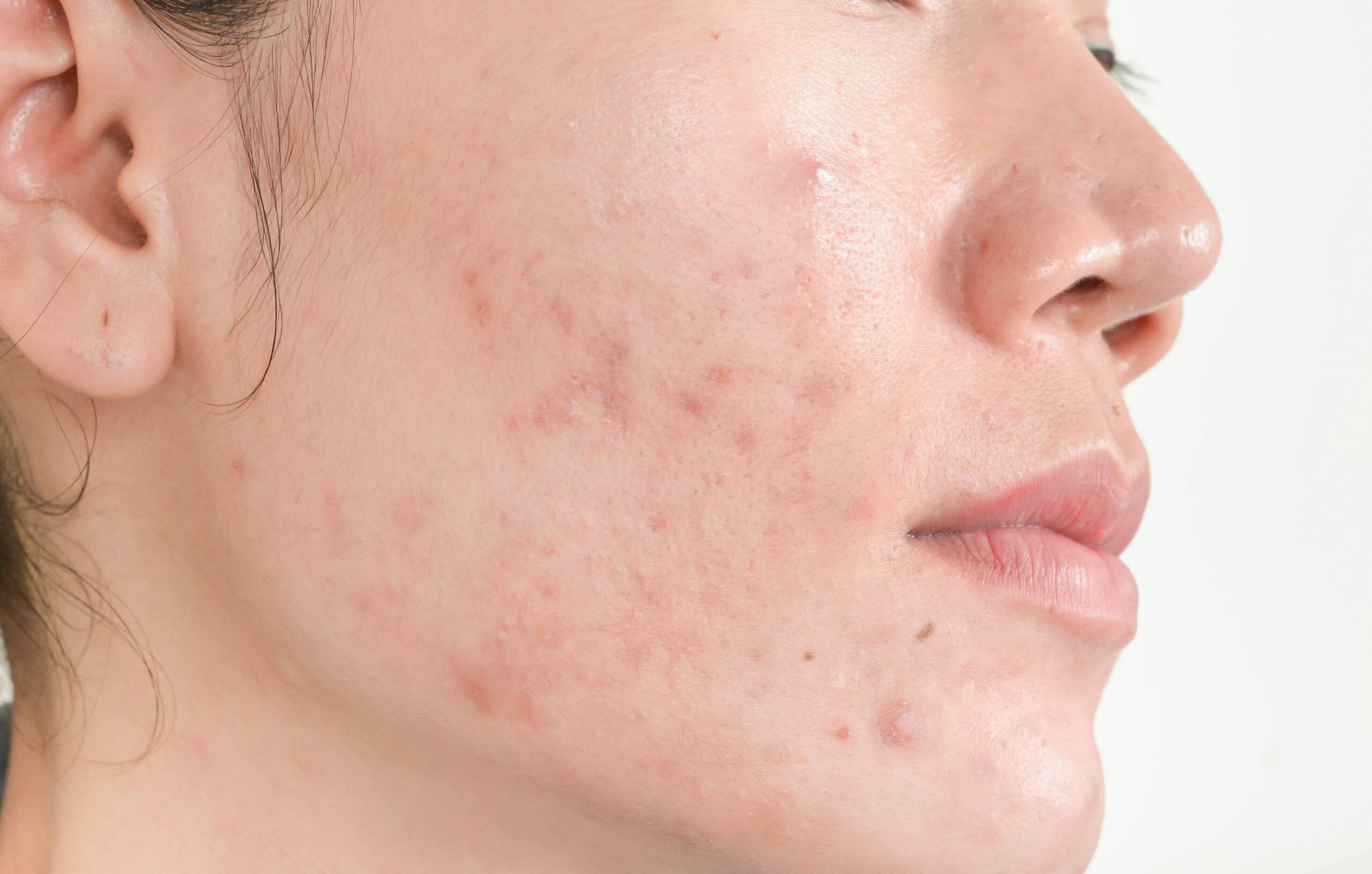 Precautions and‍ Post-Treatment Care for ‍Acne-Prone Skin