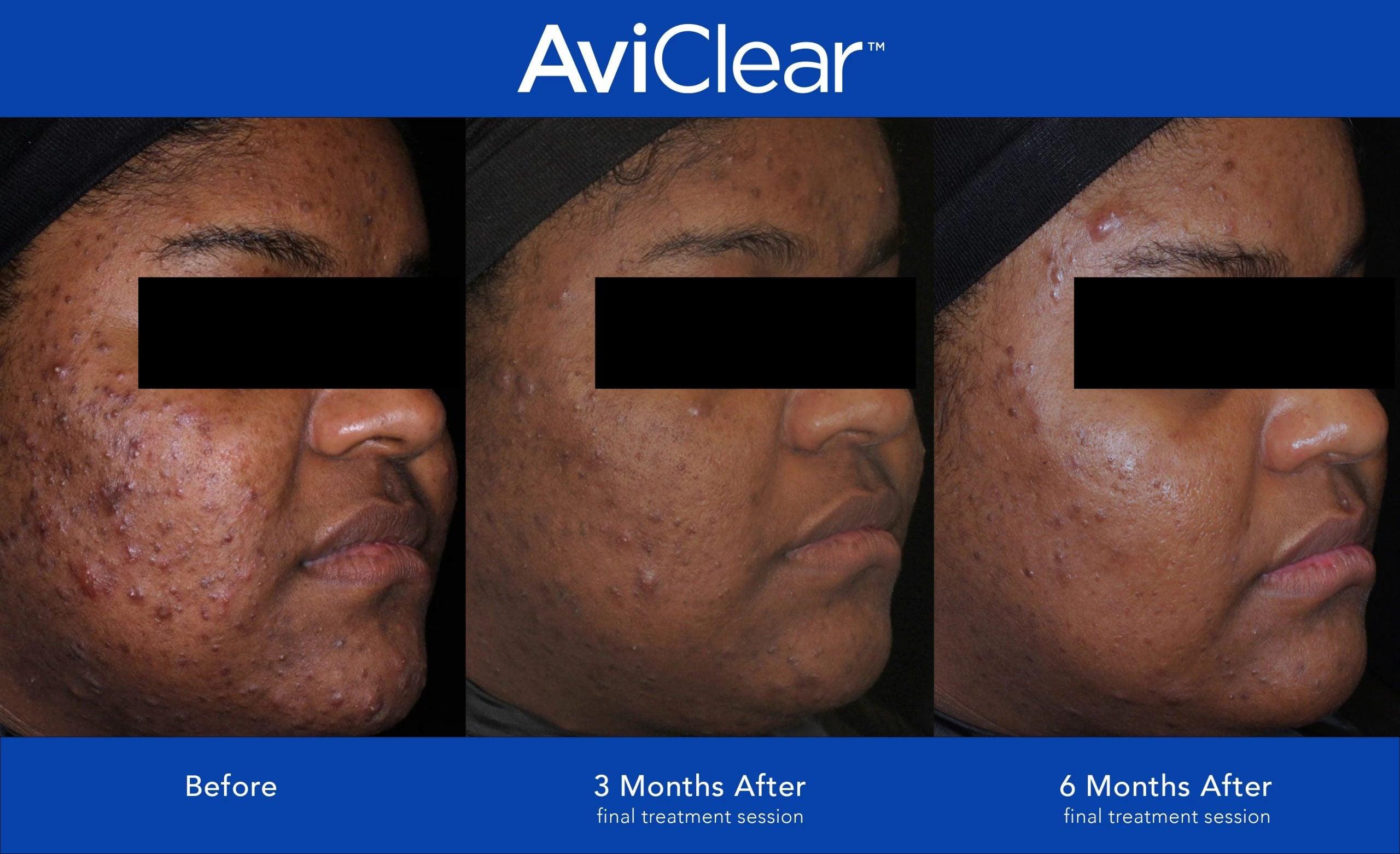 Expert Tips for Maximizing Your Essence Laser Treatment