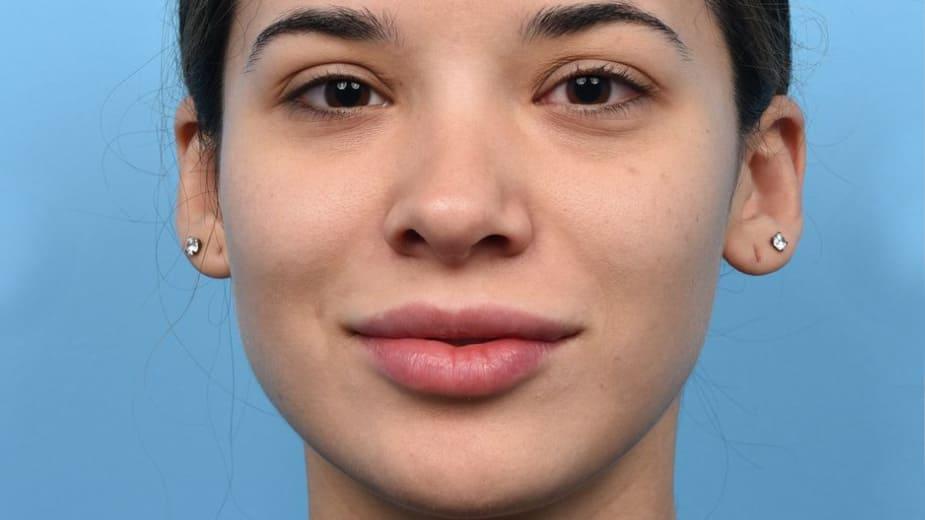 Facial Focus: Zapping Away Pesky Facial Hairs