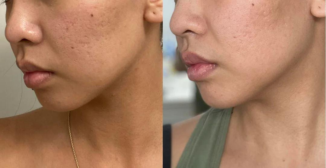 Ready, Set, Glow: Preparation Tips for Your Laser Journey