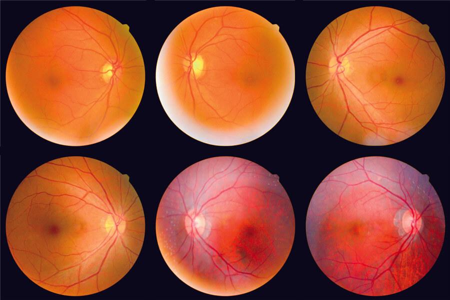 Spotting the Warning Signs: Symptoms of Retinal Damage