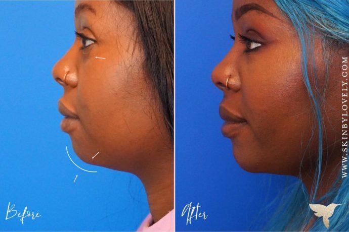 Fillers: Sculpt and Shape Your Way to Youthful Radiance