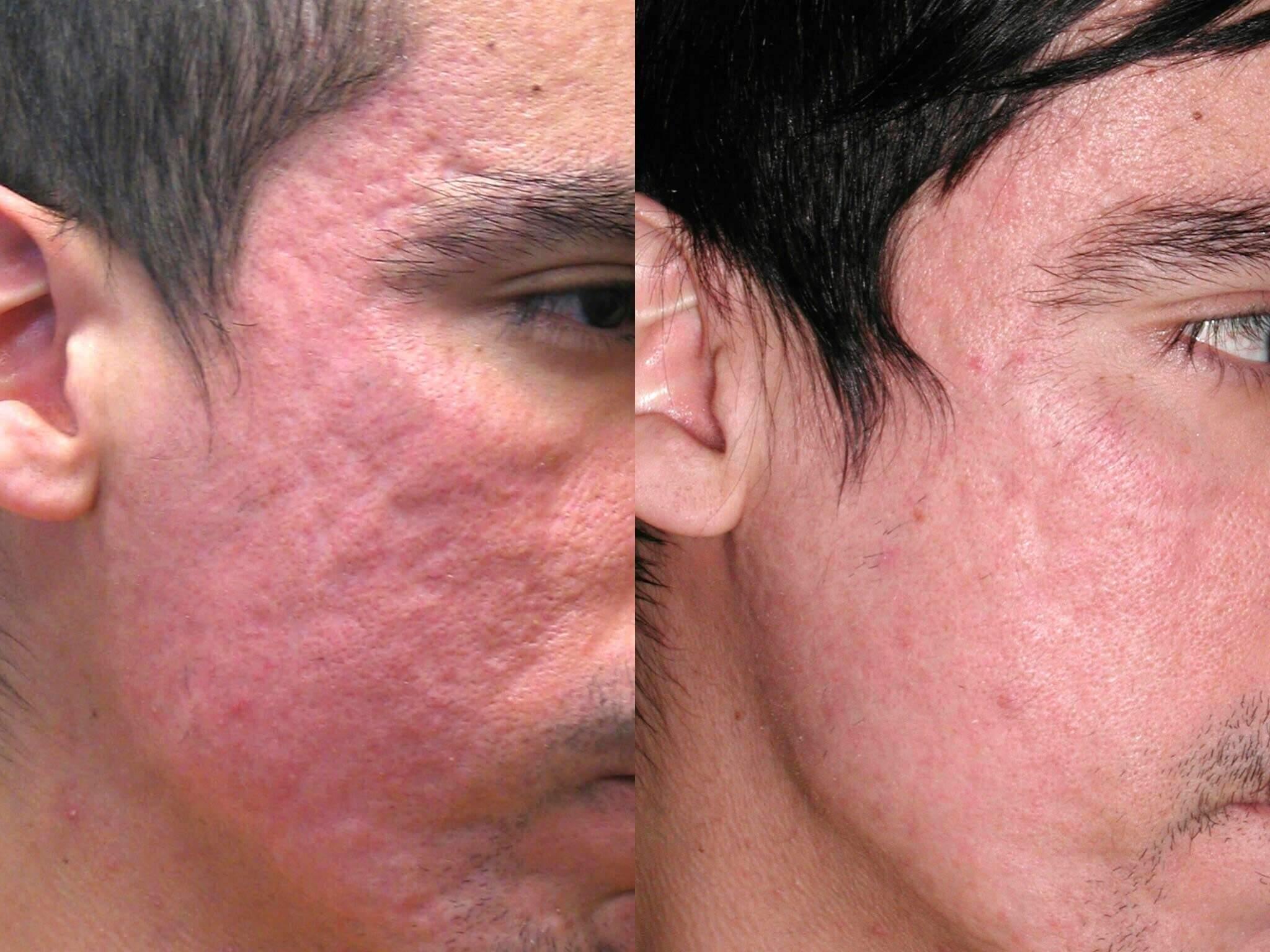 Professional Tips: Achieving a Flawless Finish with Er:YAG Laser
