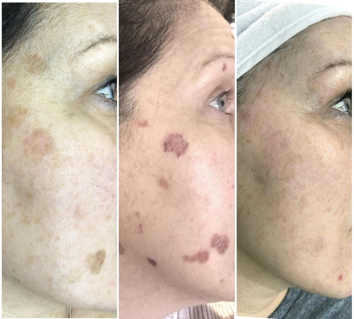 Post-Laser TLC: Nurturing Your Skin to Perfection